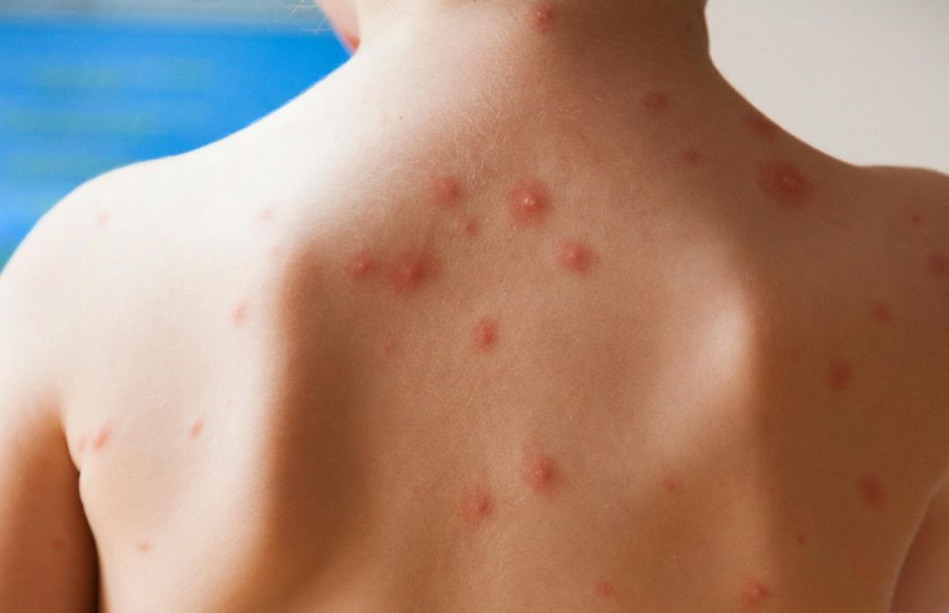 ސަމާލުވޭ ރާއްޖޭގައި ފާނަބަސަންދު އިތުރުވަނީ! ދެ ކުއްޖަކަށް  ހޮސްޕިޓަލްގައި ފަރުވާ ދެނީ