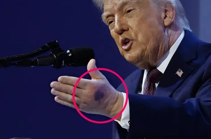 ޓްރަމްޕްގެ ސިއްހީ ހާލަތާ މެދު ބޮޑެތި ސުވާލުތަކެއް: އަތްތިލައިން ފެނުނު ނޫފައިގަތުމުގެ ސިއްރު ކޮބާ؟