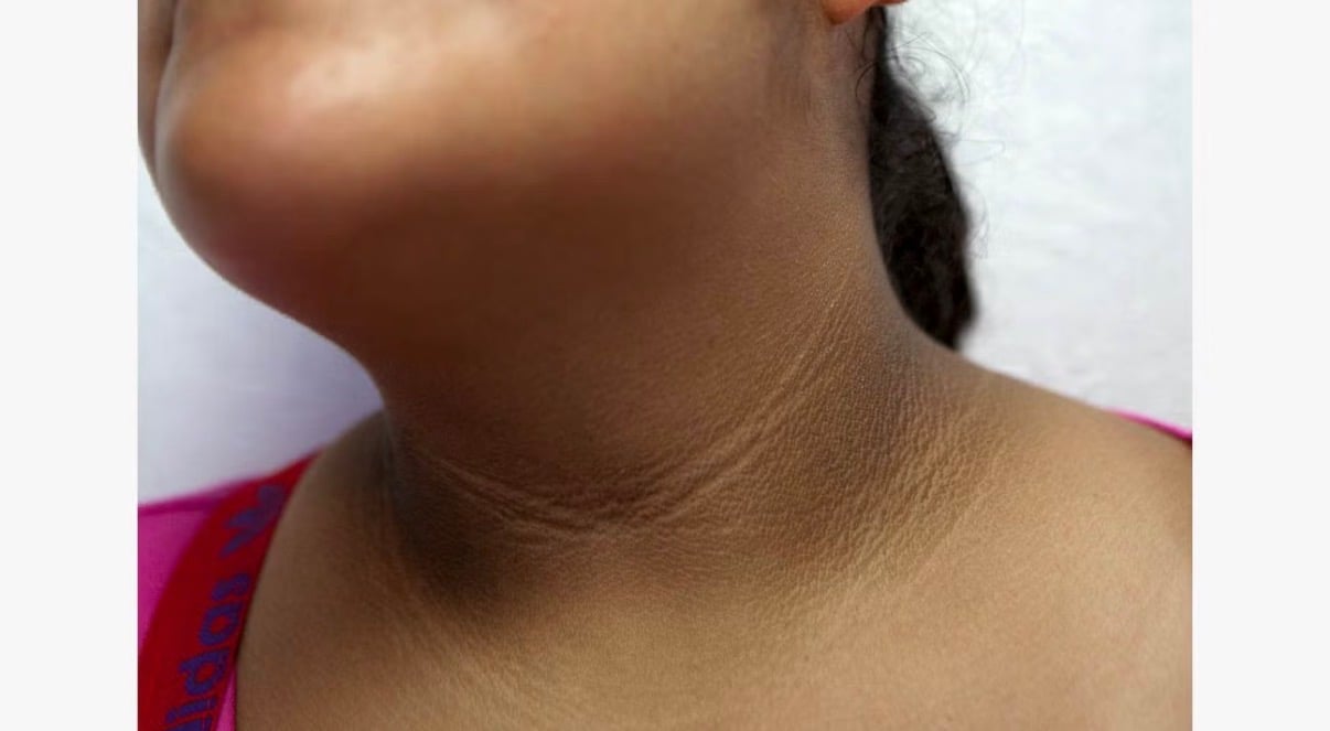 ކަރުގެ ހަންގަނޑު ކަޅުވުމަކީ އިންސިއުލިން ރެސިސްޓެންސްގެ ނުރައްކާތެރި ސިގްނަލެއް!