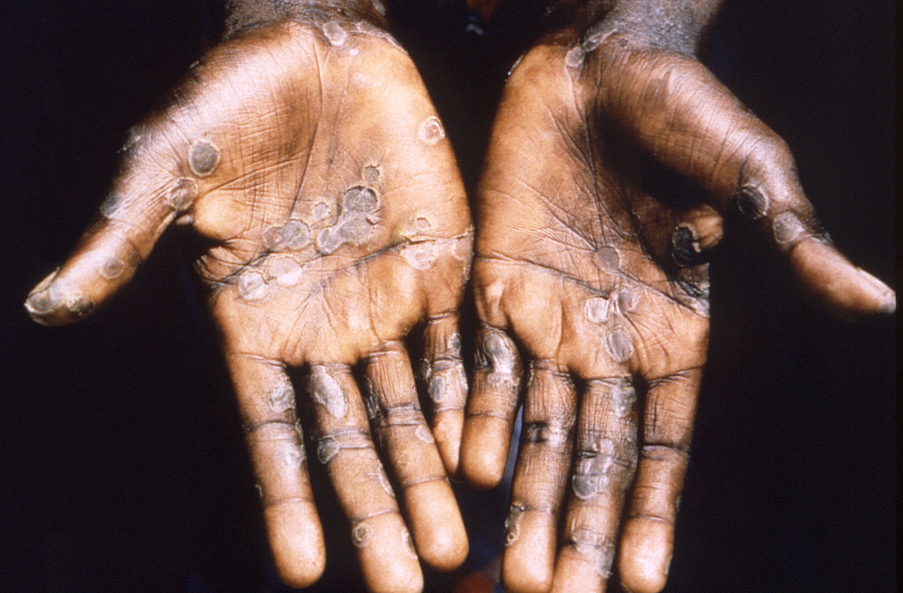 The palms of a monkeypox case patient. Picture taken in 1997. (Photo: Reuters)