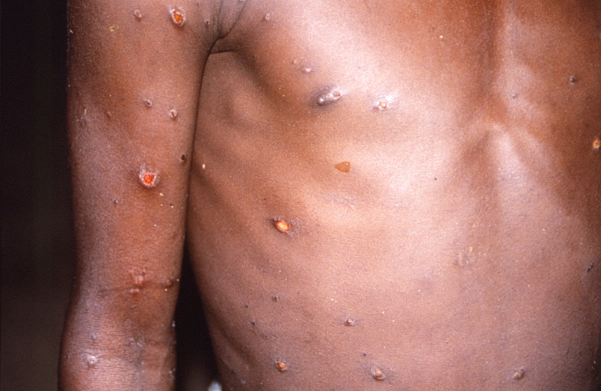An image created during an investigation into an outbreak of monkeypox in the Democratic Republic of the Congo (DRC) from 1996 to 1997
