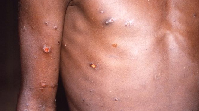 A 1997 image provided by CDC of a patient with monkeypox lesions.